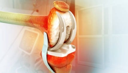 top 5 mistakes after knee replacement