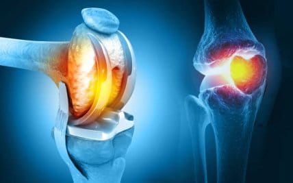 top 5 mistakes after knee replacement