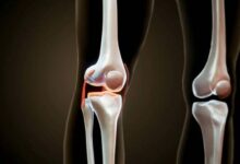 top 5 mistakes after knee replacement