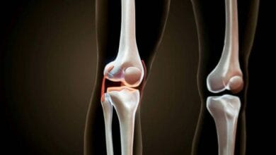 top 5 mistakes after knee replacement
